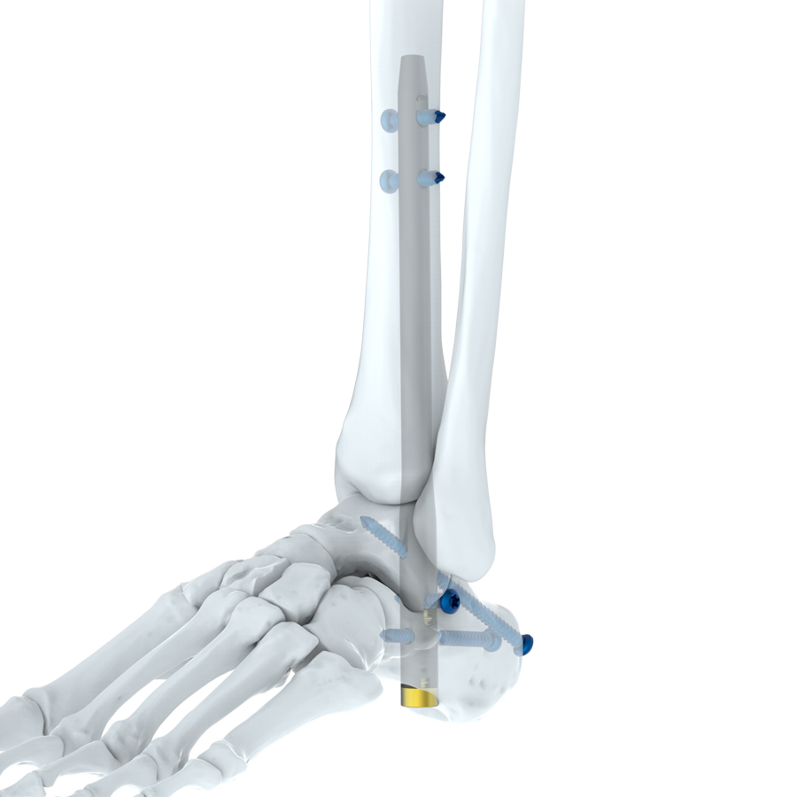 Ankle Fusion Nail