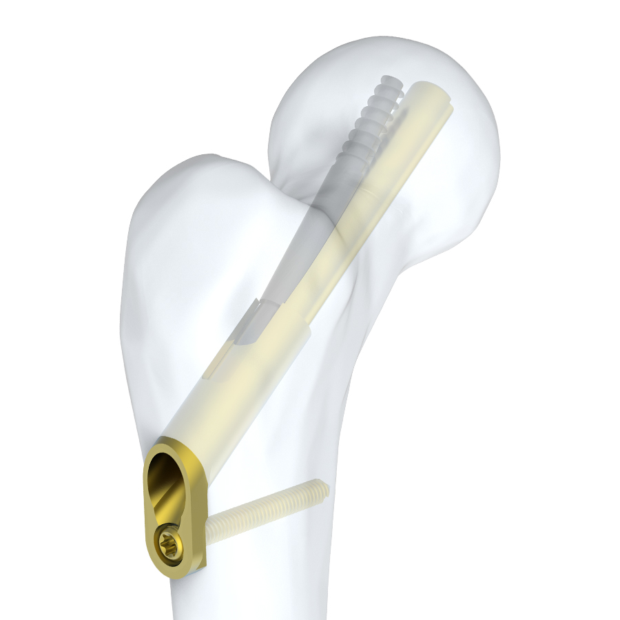 Femoral Neck System