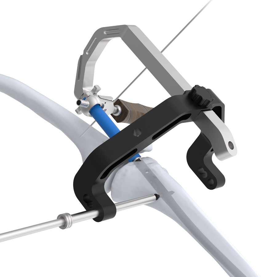 Expert Tibia Nail Suprapatellar Entry